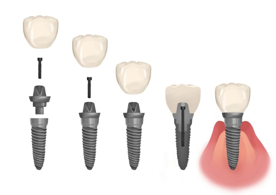 dental implant parts, broken dental implant, damaged dental implant, implant repair, Dentist at Towne Centre, West Chester OH, Dr. Mandeep Pannu, dental crown replacement, peri-implantitis treatment, implant restoration