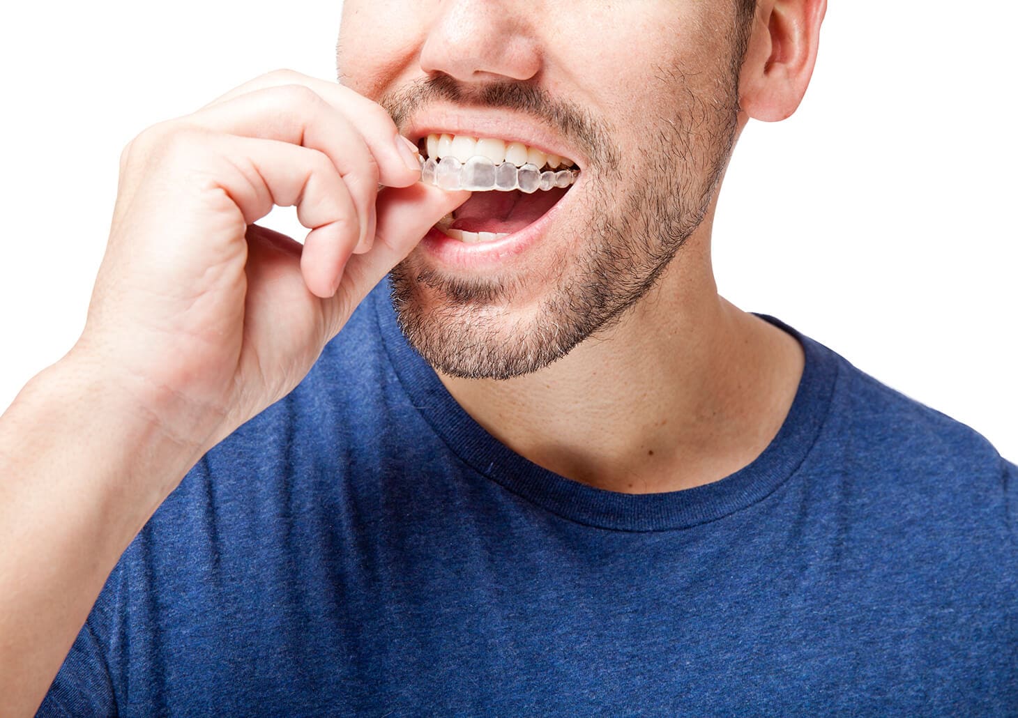 man putting a clear aligner onto his teeth